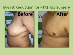 Before and after breast reduction for ftm top surgery at Elegance Transgender Clinic, Surat