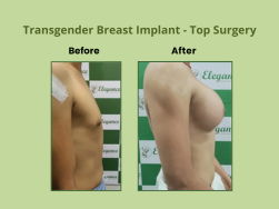 Before and after transgender breast implant, top surgery at Elegance Transgender Clinic, Surat
