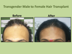 Before and after male to female hair transplant at Elegance Transgender Clinic, Surat