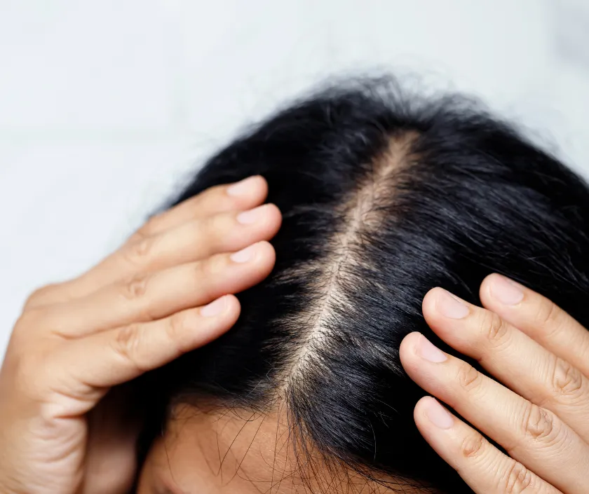 Hairline Recession in Trans Women care at Elegance Transgender Clinic, Surat