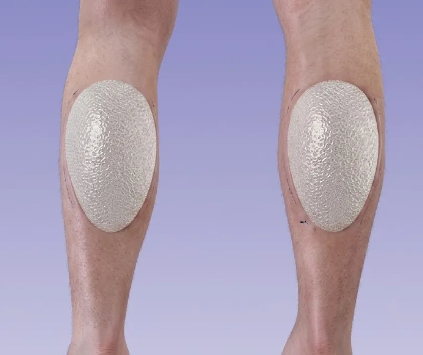 Calf Implants, Elegance Transgender Clinic, Surat Calf Implants at Elegance Transgender Clinic, Surat