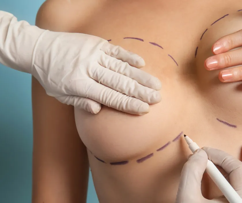 Fat Transfer Breast Augmentation at Elegance Transgender Clinic, Surat