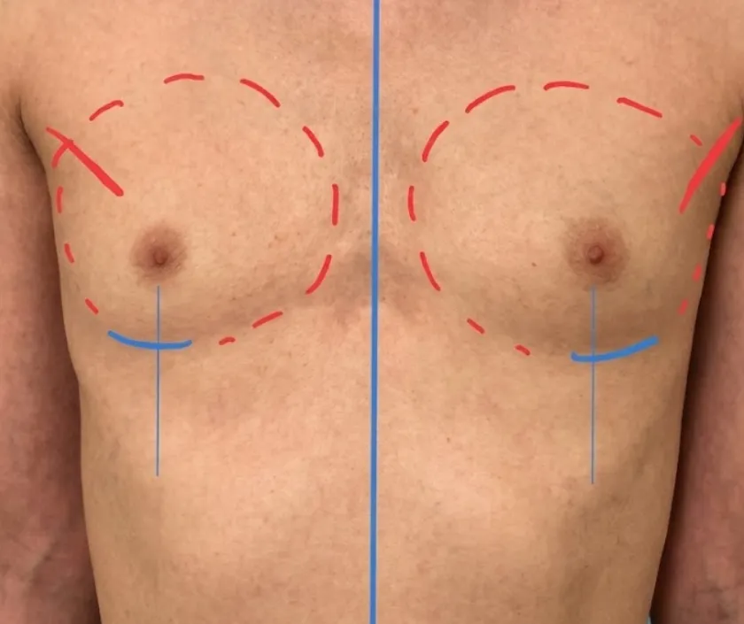 Breast Augmentation at Elegance Transgender Clinic, Surat