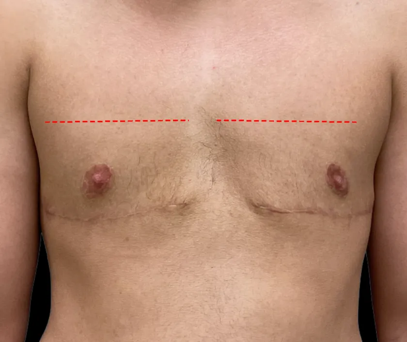 Top Surgery (Chest Masculinization) at Elegance Transgender Clinic, Surat