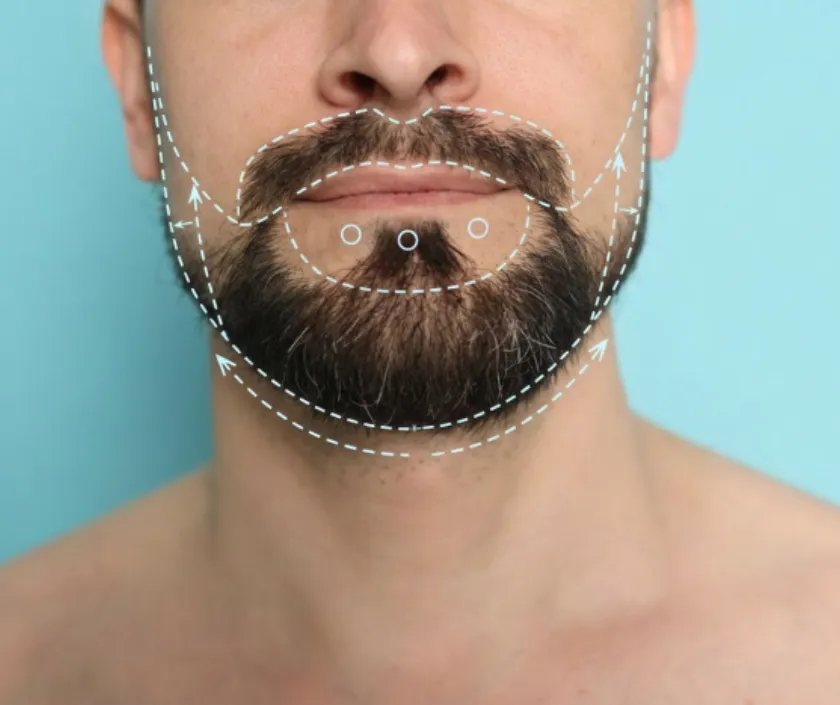 Facial Hair facial masculinization procedures at Elegance Transgender Clinic, Surat