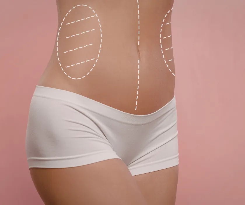 Hip to Waist Ratio Contouring at Elegance Transgender Clinic, Surat