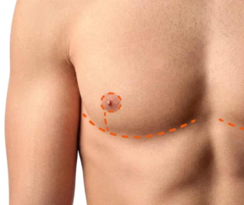 Inverted T (Anchor Scar) Top Surgery at Elegance Transgender Clinic, Surat