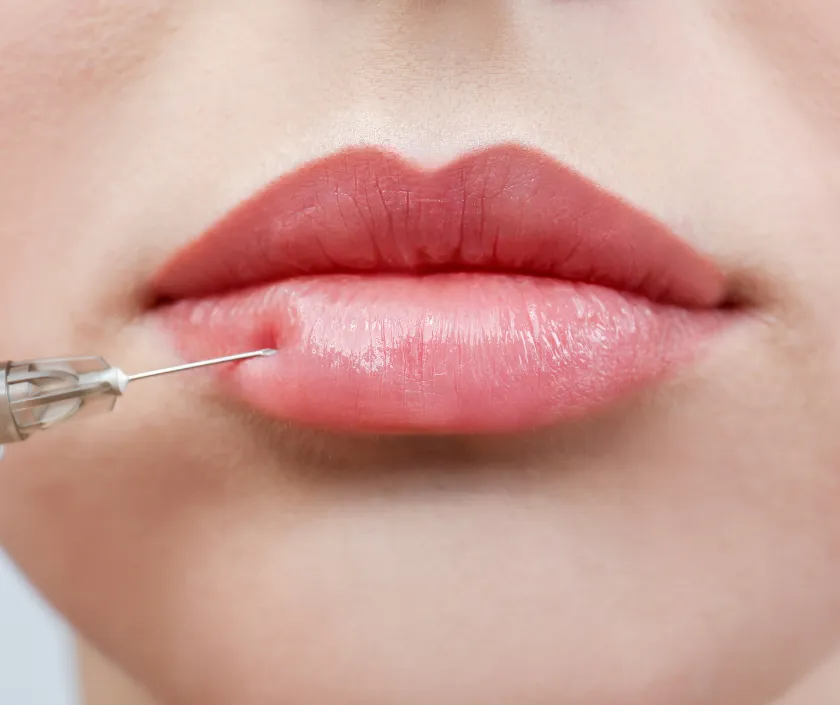 Lip Lift (Philtrum Shortening) at Elegance Transgender Clinic, Surat