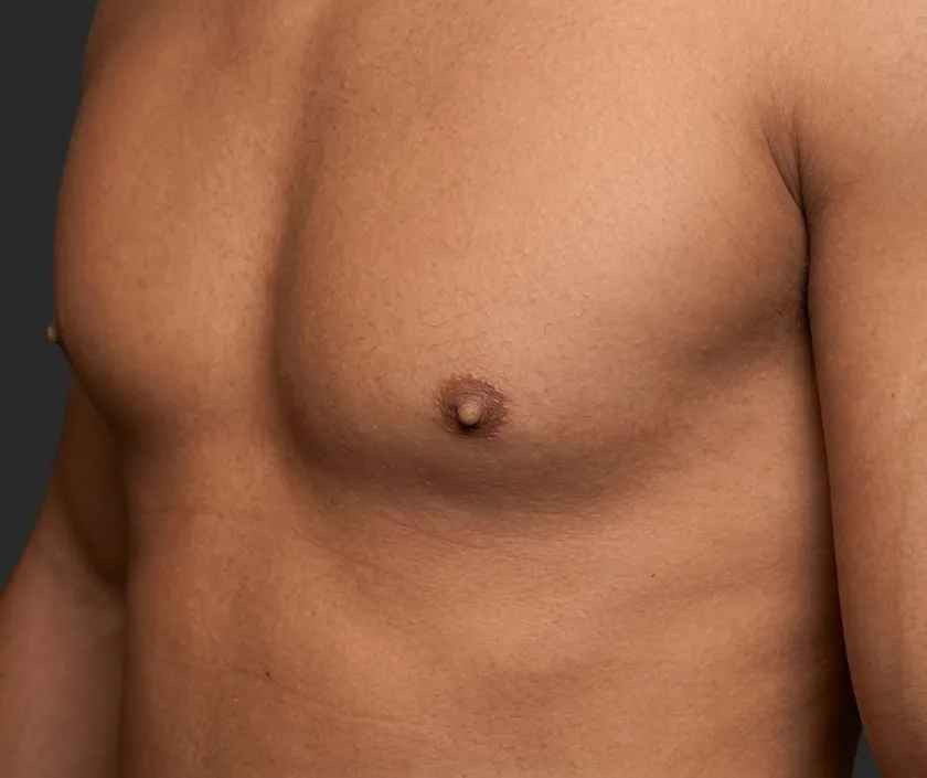 Nipple and Areola Reconstruction at Elegance Transgender Clinic, Surat