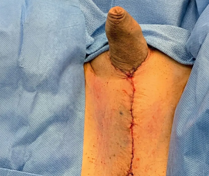 Orchiectomy at Elegance Transgender Clinic, Surat