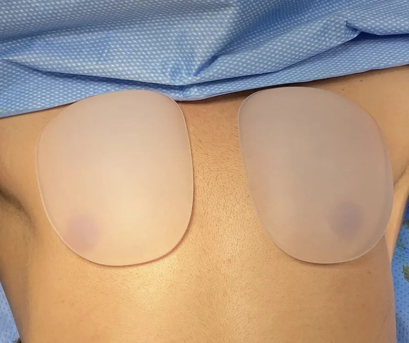 Pectoral Implants at Elegance Transgender Clinic, Surat