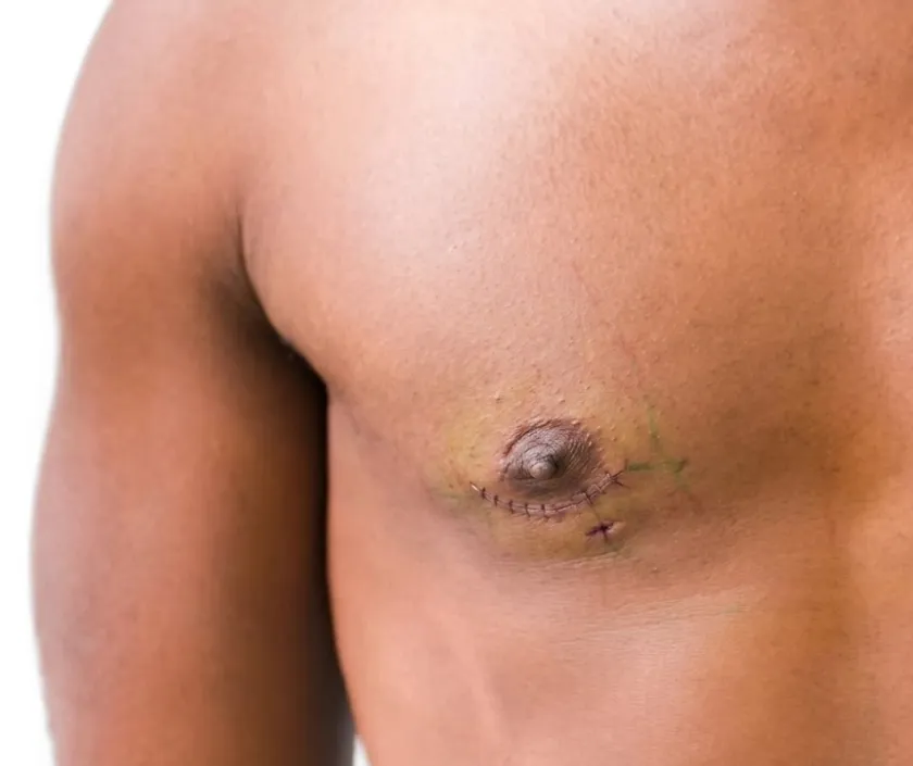 Periareolar Top Surgery at Elegance Transgender Clinic, Surat