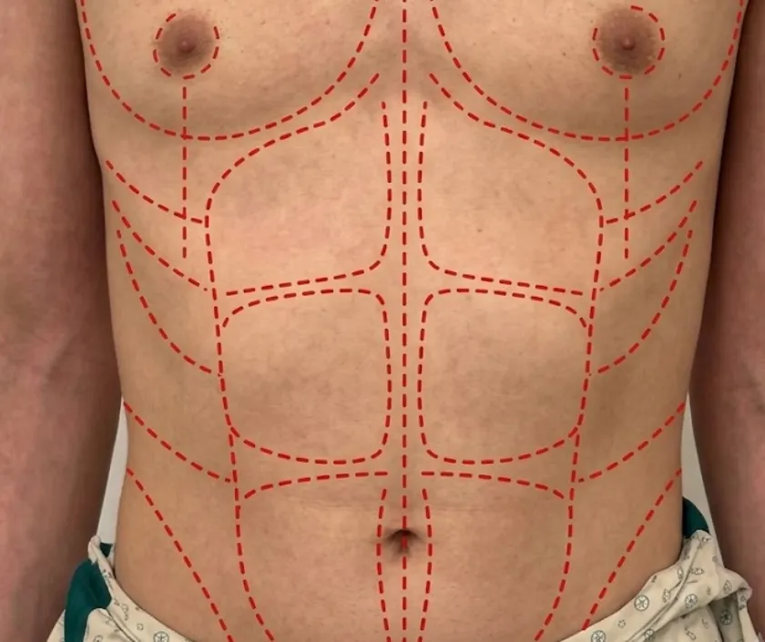 Hi Def Six Pack Etching at Elegance Transgender Clinic, Surat