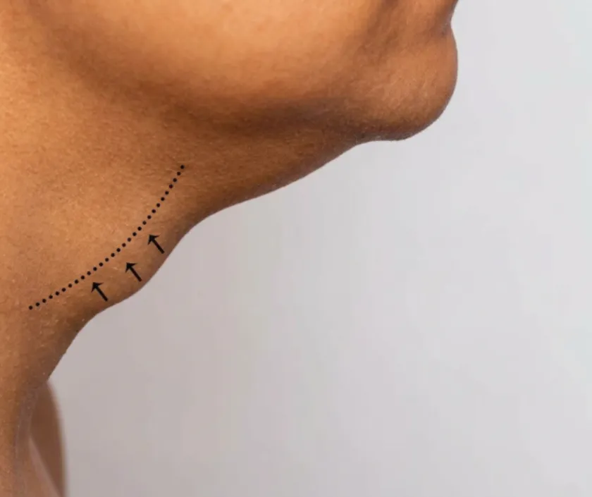 Prominent Adam's Apple care at Elegance Transgender Clinic, Surat