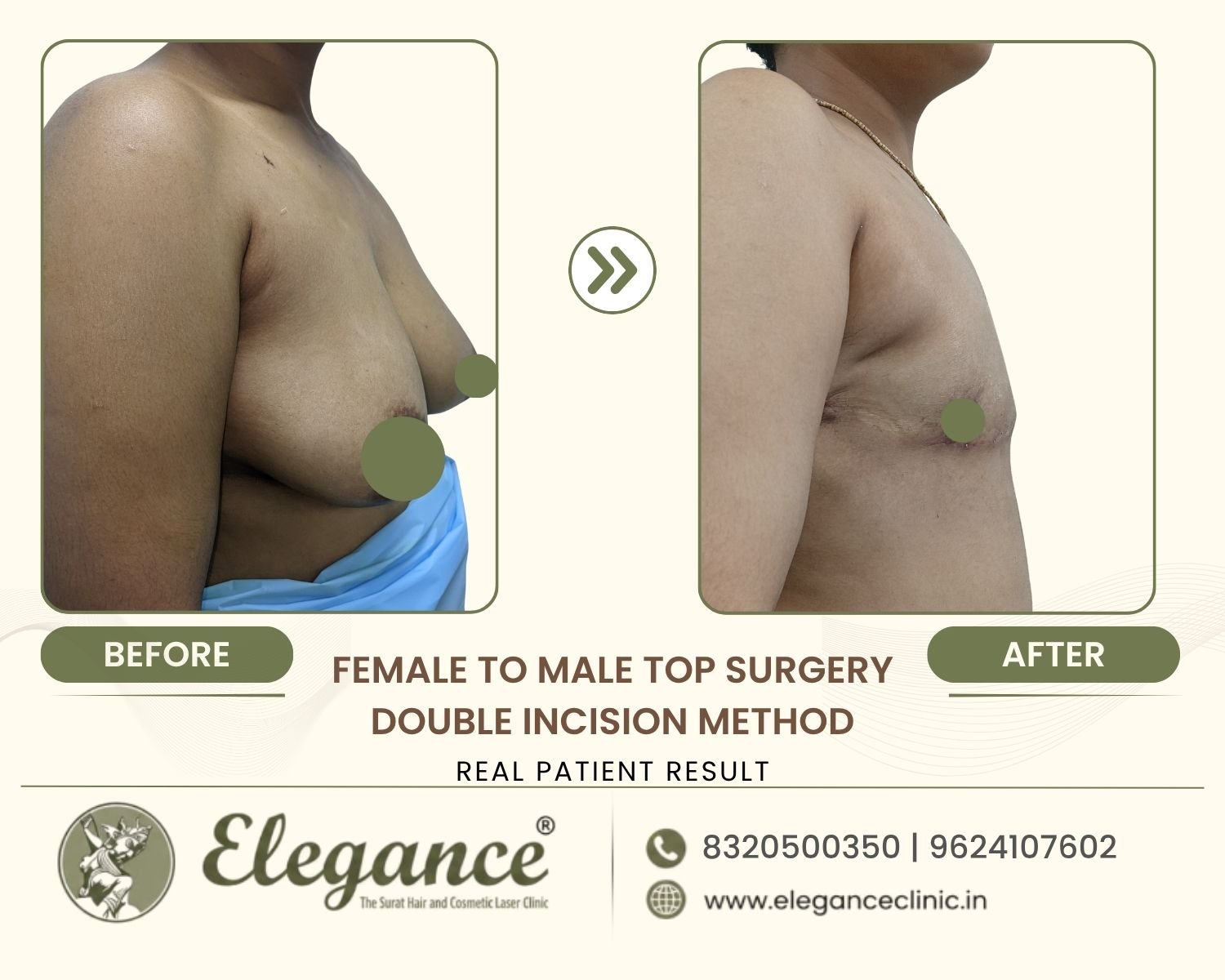 Before and after side view FTM top surgery double incision at Elegance Transgender Clinic, Surat