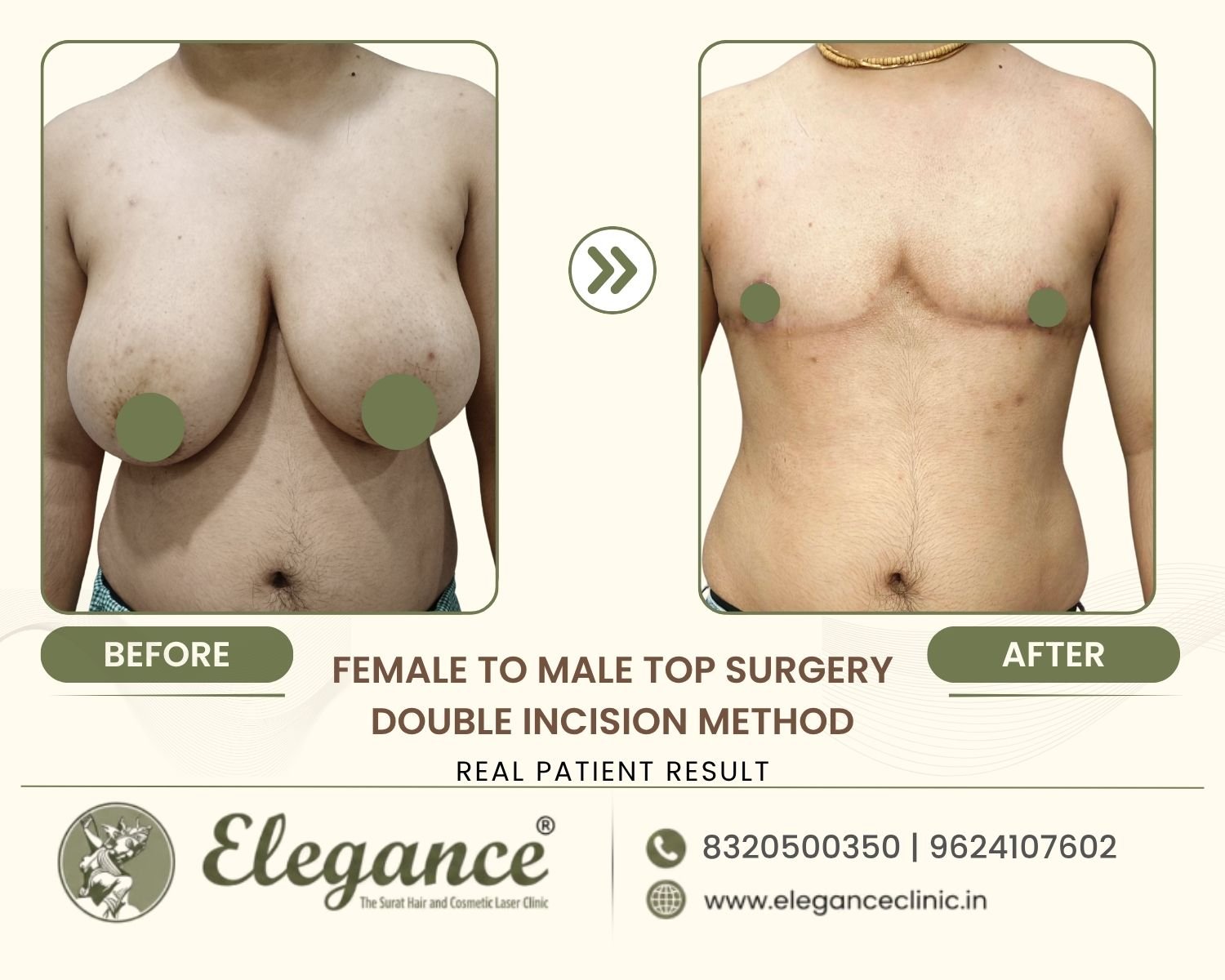 Before and after large chest reduction for ftm top surgery at Elegance Transgender Clinic, Surat