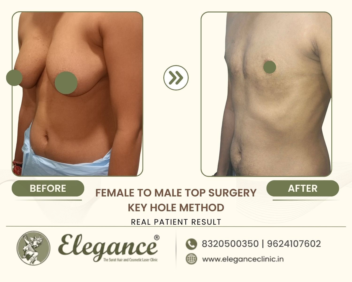 Before and after trans male keyhole chest surgery at Elegance Transgender Clinic, Surat