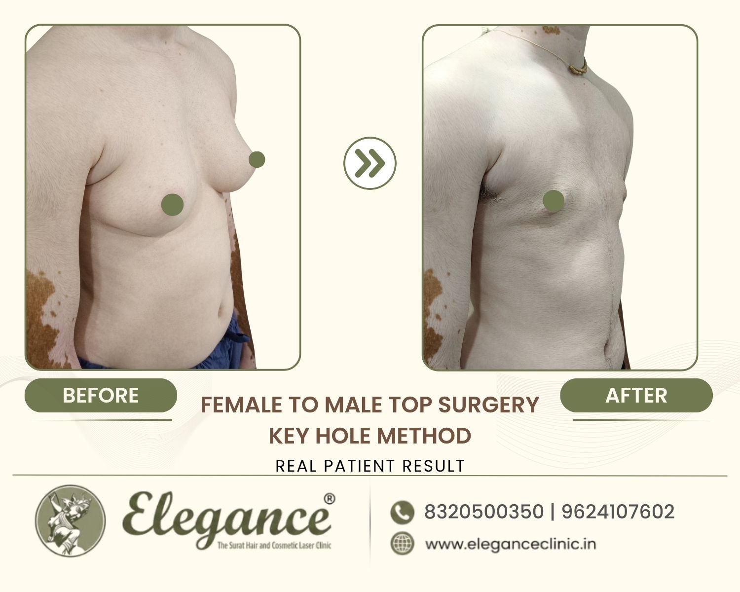 Before and after right angle view FTM keyhole chest surgery at Elegance Transgender Clinic, Surat