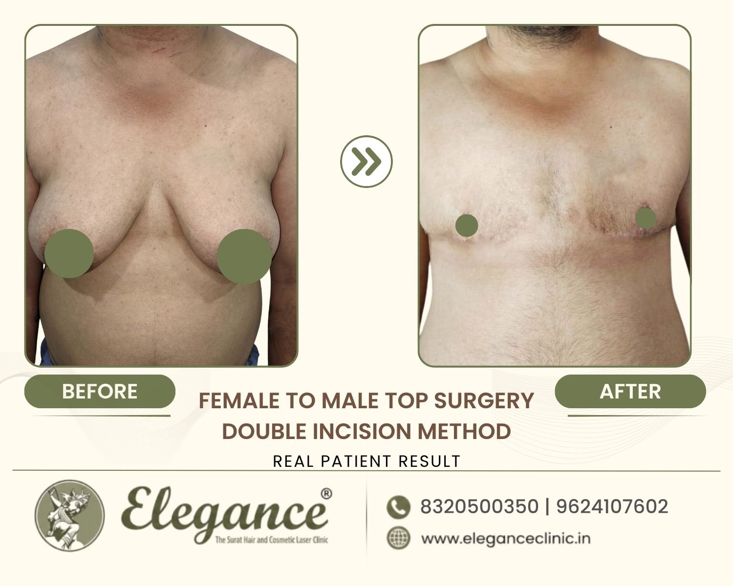 Before and after front view FTM top surgery double incision at Elegance Transgender Clinic, Surat