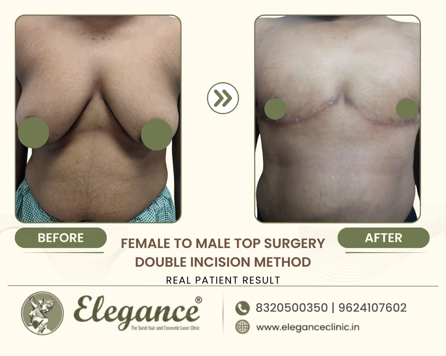 Before and after FTM double incision top surgery flat chest result at Elegance Transgender Clinic, Surat