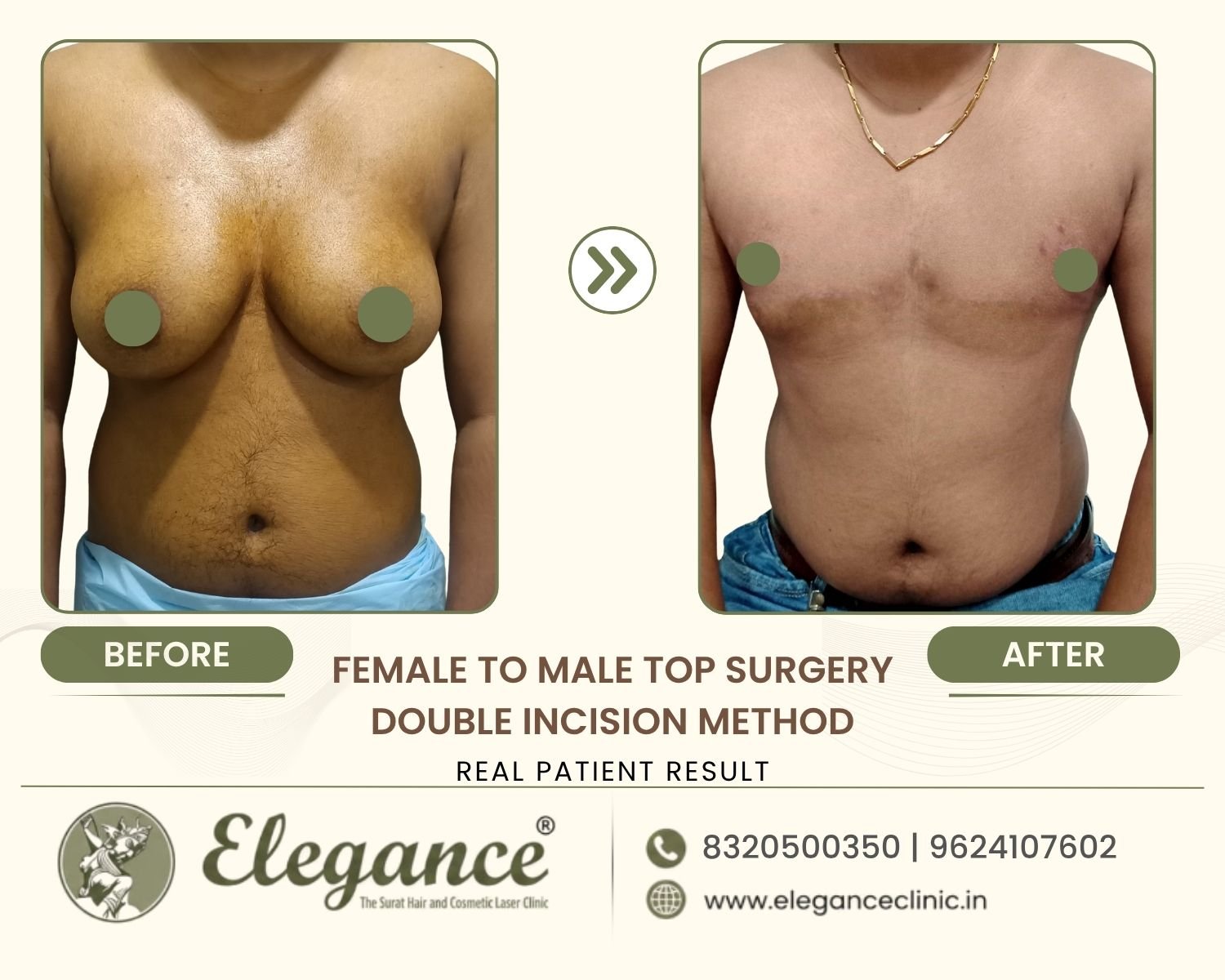 Before and after FTM chest masculinization with double incision method at Elegance Transgender Clinic, Surat