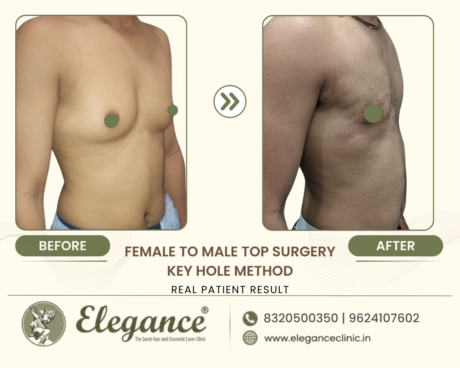 Before and after oblique view FTM top surgery keyhole method at Elegance Transgender Clinic, Surat
