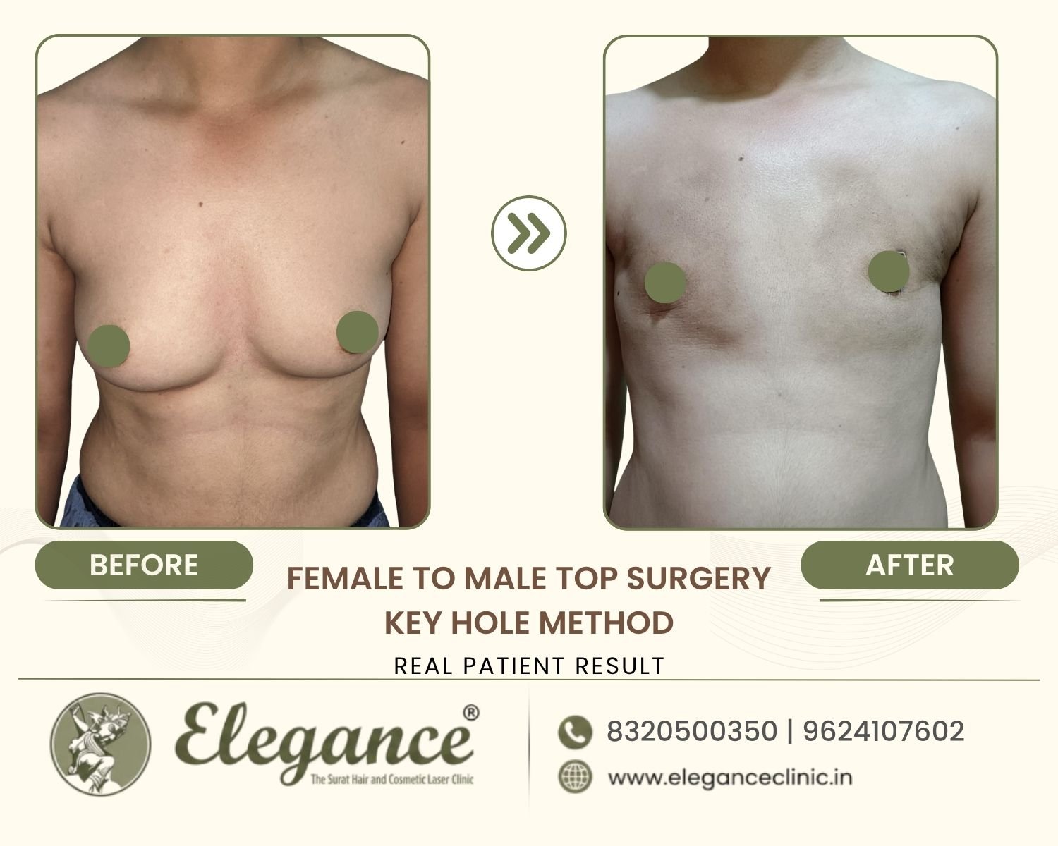 Before and after front view FTM keyhole top surgery at Elegance Transgender Clinic, Surat